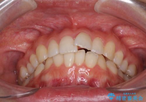 口が閉じにくい 1本飛び出した前歯の矯正治療の治療前