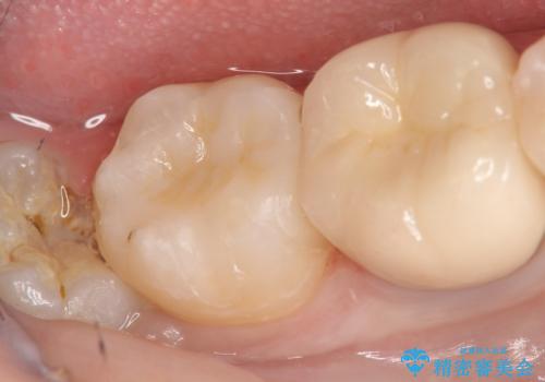 セラミックインレー 古い銀歯の治療の治療後