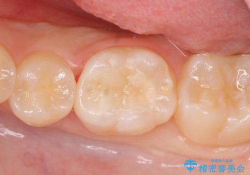 セラミックインレー　しみる歯の治療の症例 治療後