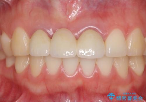 歯肉から血が　前歯のオールセラミックブリッジの再製作の治療前