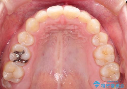 前歯が八重歯でガタガタ ワイヤーによる抜歯矯正の治療後