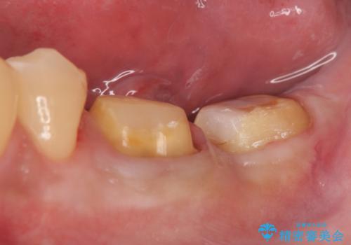 歯冠長延長術を併用した審美的歯科治療の治療中
