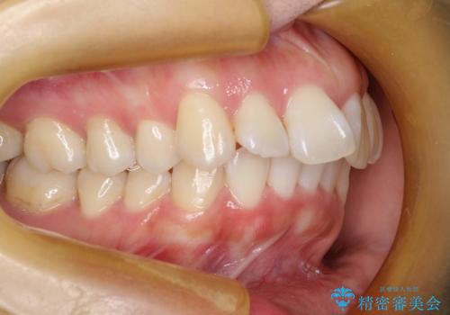 抜歯をして前歯を下げ、ガタつきを取り除く ワイヤー矯正の治療前