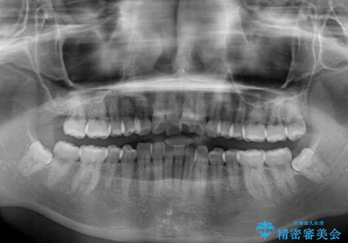 口が閉じにくい 1本飛び出した前歯の矯正治療の治療前