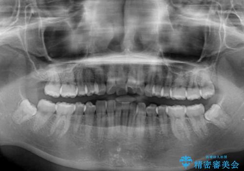 口が閉じにくい　1本飛び出した前歯の矯正治療の治療前
