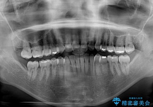 前歯の叢生を治したい　インビザラインによる矯正治療の治療前