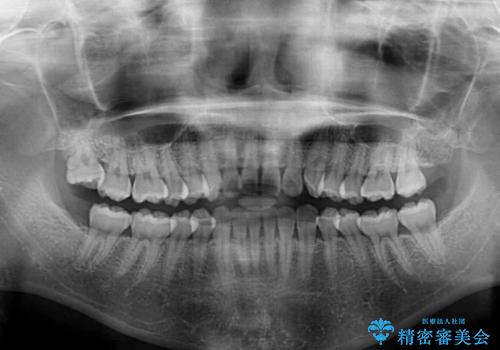 前歯のデコボコを治したい　インビザラインによる矯正治療の治療前