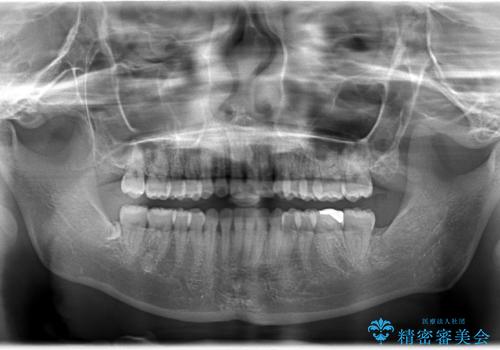 インビザラインによるガタつきの矯正治療 シンプル・短期間の治療後