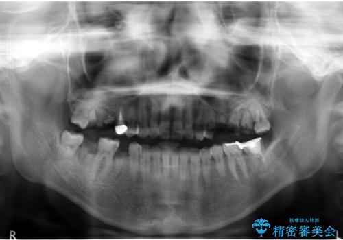 自家歯牙移植 使っていない親知らずを移植 20代女性の治療前