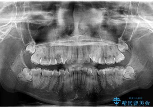 抜歯矯正で口元に変化を ラビアル・ワイヤー矯正でEラインの治療前