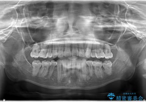 抜歯矯正で口元に変化を ラビアル・ワイヤー矯正でEラインの治療後