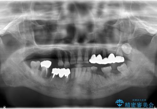 虫歯だらけ、歯周病 崩壊した口腔の再建 フルマウスリコンストラクションの治療前