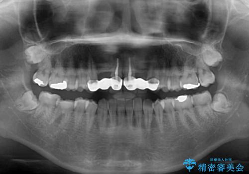気になる前歯を審美歯科治療と矯正歯科治療で美しくの治療前