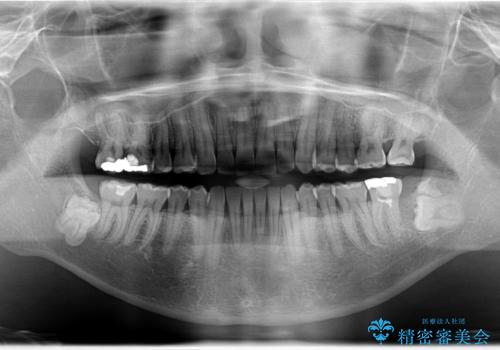 インビザライン invisalign ガタつきを治すマウスピース矯正の治療後