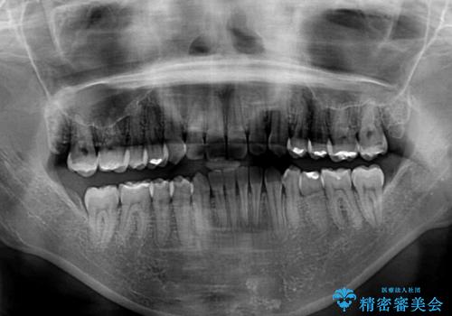 前歯の叢生を治したい インビザラインによる矯正治療の治療後
