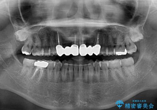 気になる前歯を審美歯科治療と矯正歯科治療で美しくの治療後