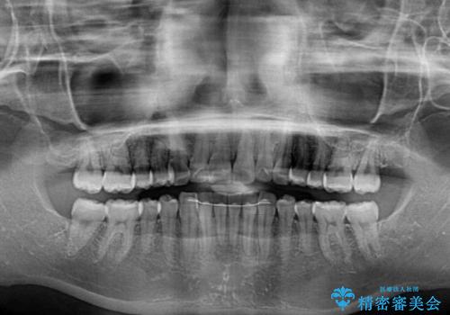 口が閉じにくい 1本飛び出した前歯の矯正治療の治療後