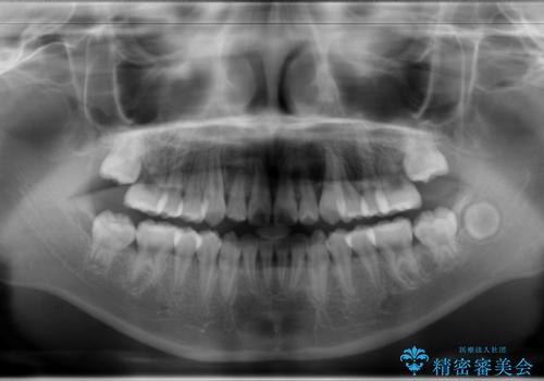 永久歯が生えてこない　ワイヤー矯正で複雑な状態を正常咬合へ誘導するの治療後