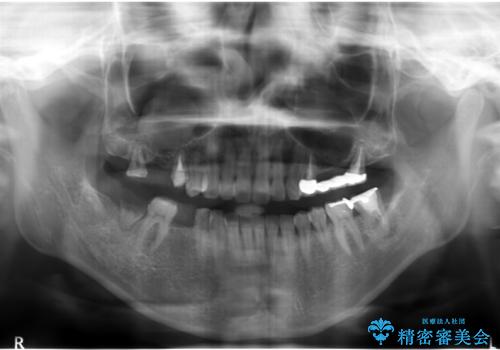 自家歯牙移植 使っていない親知らずを移植 20代女性の治療後