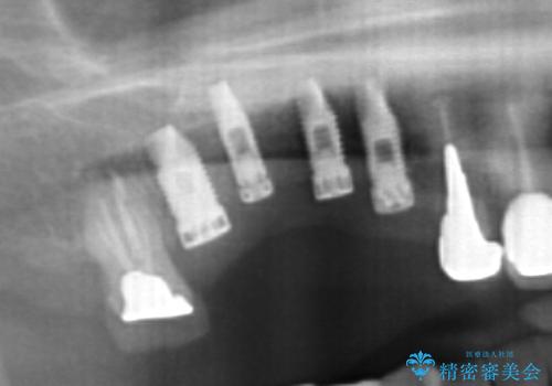 他院で中途半端に終わってしまったインプラント治療 の治療後