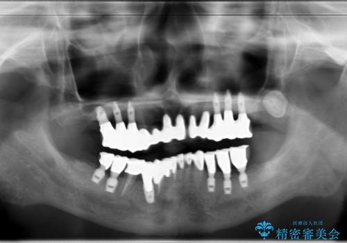 虫歯だらけ、歯周病 崩壊した口腔の再建 フルマウスリコンストラクションの治療後