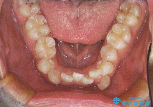 前歯が八重歯でガタガタ ワイヤーによる抜歯矯正の治療前