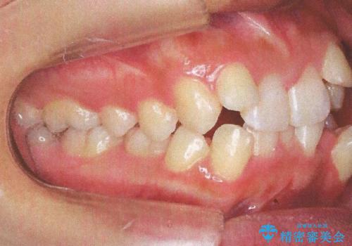 前歯が八重歯でガタガタ　ワイヤーによる抜歯矯正の治療前