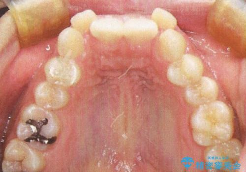 前歯が八重歯でガタガタ ワイヤーによる抜歯矯正の治療前