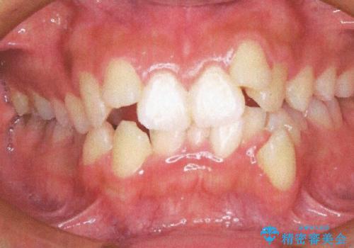 前歯が八重歯でガタガタ　ワイヤーによる抜歯矯正の症例 治療前