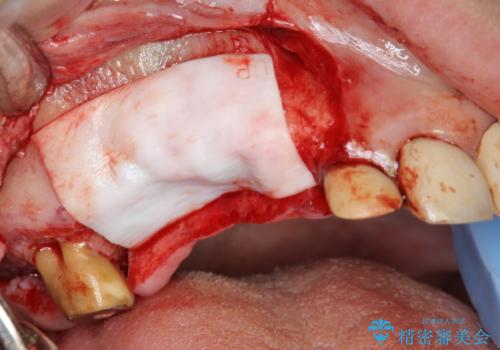 他院で中途半端に終わってしまったインプラント治療 の治療後
