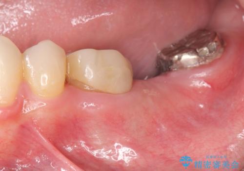 最後方臼歯のインプラント補綴の症例 治療前