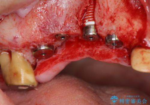 他院で中途半端に終わってしまったインプラント治療 の治療前