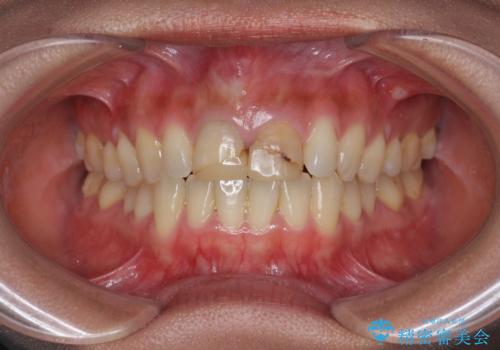 短期集中  前歯審美治療の治療前