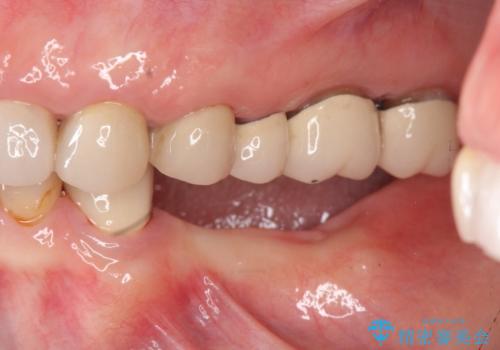 歯を失い噛めない、インプラントによる咬合機能回復の治療前