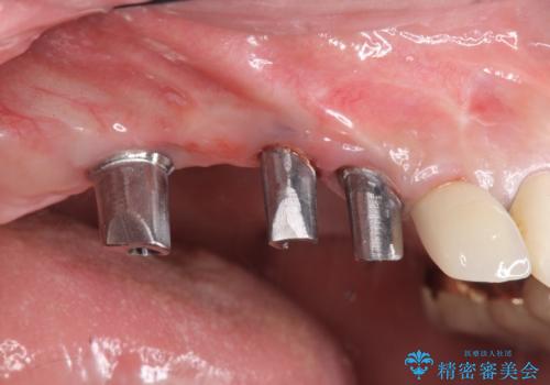 他院で中途半端に終わってしまったインプラント治療 の治療中