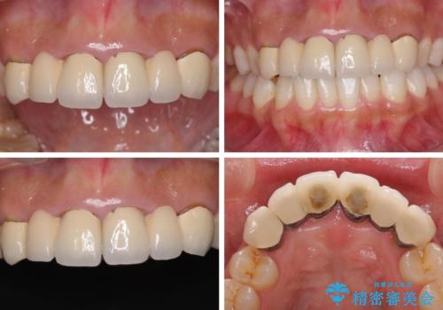 気になる前歯を審美歯科治療と矯正歯科治療で美しくの治療前