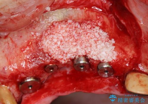 他院で中途半端に終わってしまったインプラント治療