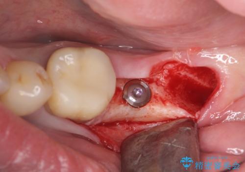 最後方臼歯のインプラント補綴の治療中