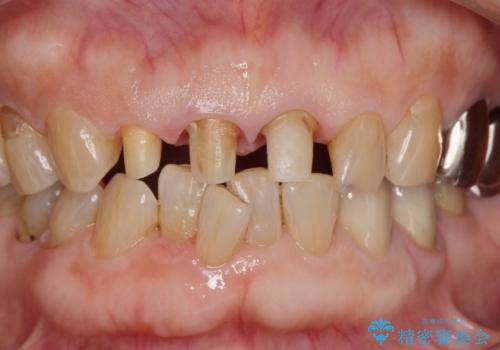前歯の審美改善の治療中