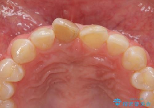 前歯をきれいにしたい ジルコニアクラウンによる審美治療の治療前