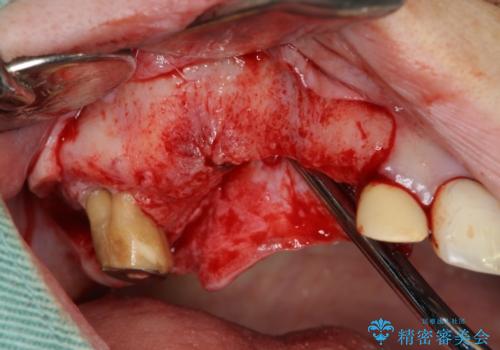 他院で中途半端に終わってしまったインプラント治療 の治療中