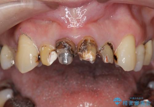 歯茎の黒ずみがきになる　前歯の見た目を改善したいの治療前