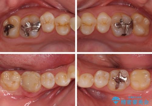 気になる前歯を審美歯科治療と矯正歯科治療で美しくの治療前