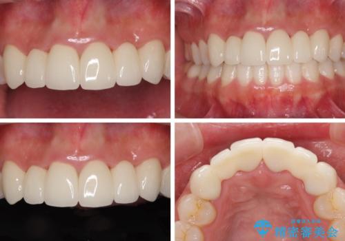気になる前歯を審美歯科治療と矯正歯科治療で美しくの治療後