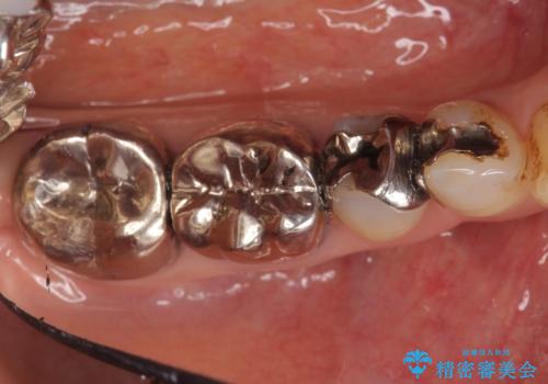 オールセラミッククラウン　PGA(ゴールド)クラウン　古い銀歯の治療の症例 治療前