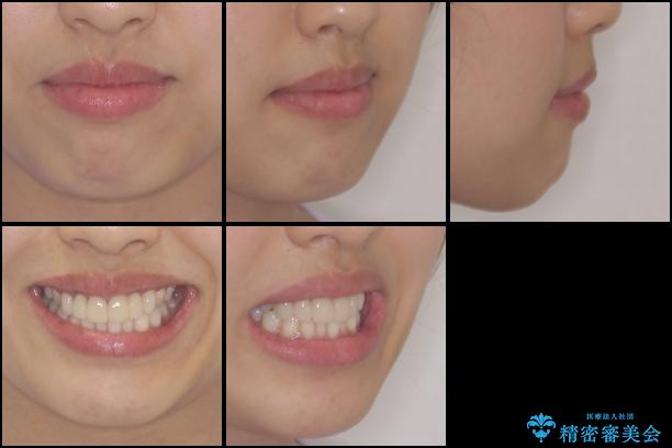 気になる前歯を審美歯科治療と矯正歯科治療で美しくの治療前（顔貌）