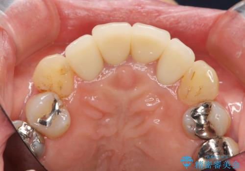 歯茎の黒ずみがきになる 前歯の見た目を改善したいの治療後