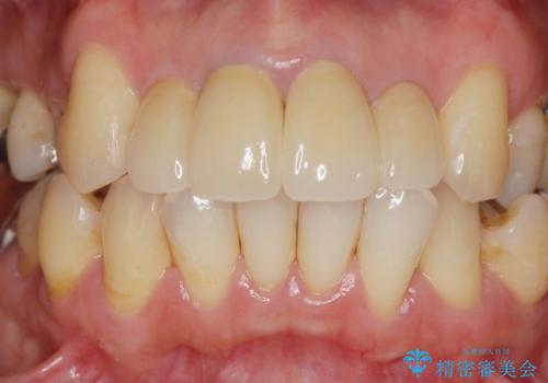 歯茎の黒ずみがきになる 前歯の見た目を改善したいの治療後