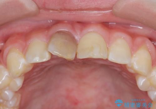 前歯をきれいにしたい ジルコニアクラウンによる審美治療の治療前