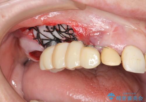 他院で中途半端に終わってしまったインプラント治療 の治療中